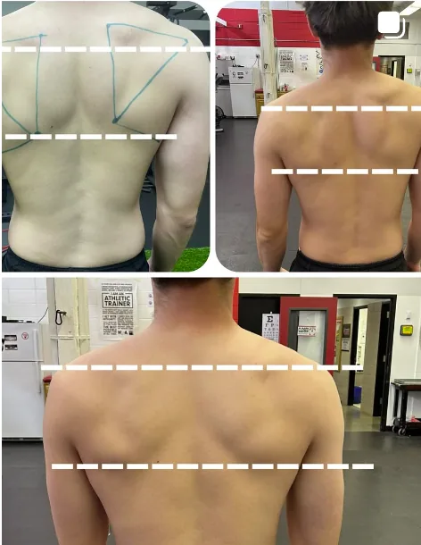 Before-and-after shoulder position comparison from a throwing athlete with functional thoracic outlet symptoms